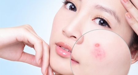 Nhiều sai lầm trong chữa… mụn