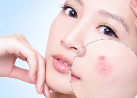 Nhiều sai lầm trong chữa… mụn